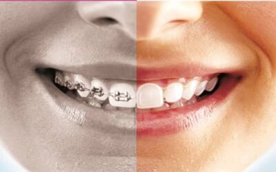 Braces vs. Aligners: Which is Right for You?