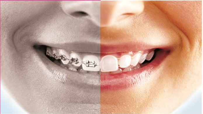 Braces vs. Aligners: Which is Right for You?